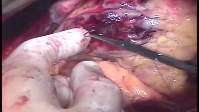 Repair of Postinfarction VSD