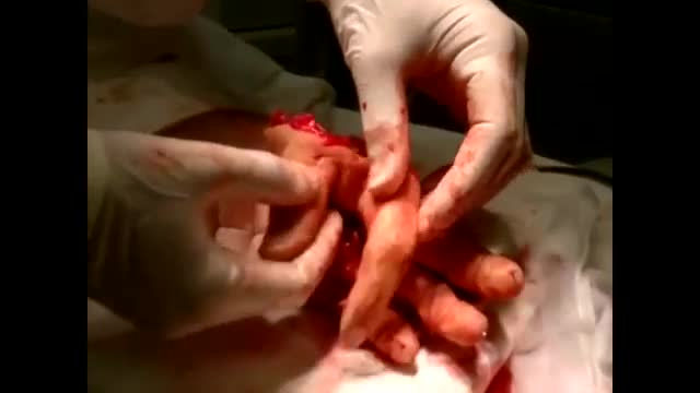 ⁣Replantation after amputation of 5 fingers