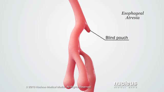 Tracheoesophageal Fistula