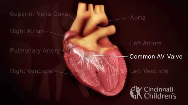 ⁣Atrioventricular Septal Defect