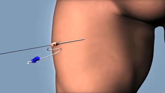 Ventricular Septal Defect device closure