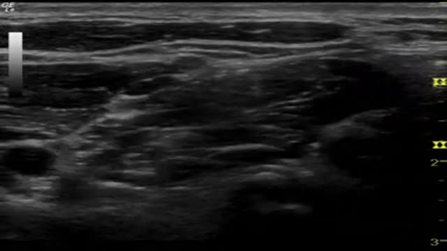 ⁣Ultra Sound-Guided Interscalene Block