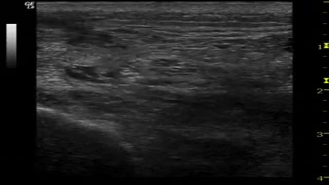 UltraSound-guided Sciatic nerve block