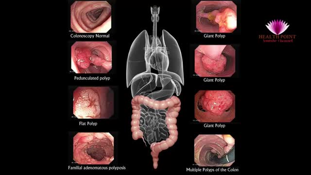 ⁣Colon and Rectal Cancer