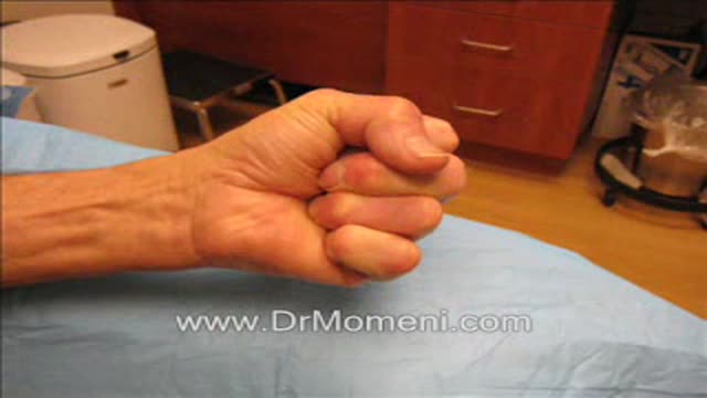 ⁣Needle Aponeurotomy Dupuytren's Contracture