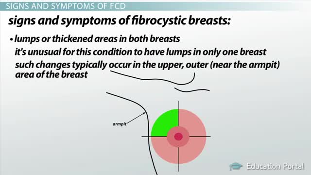 Fibrocystic Breast Disease