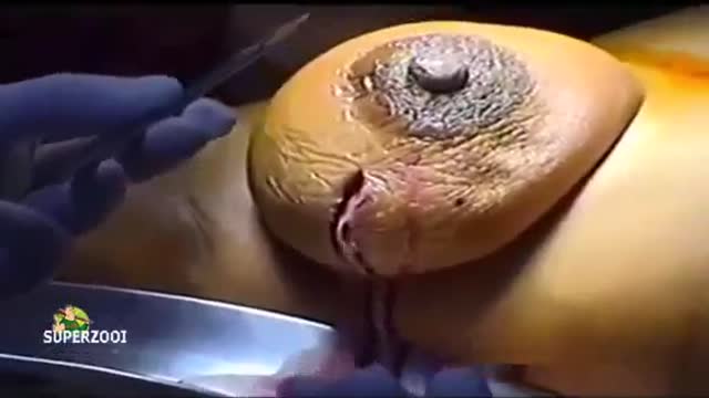 Breast Abscess