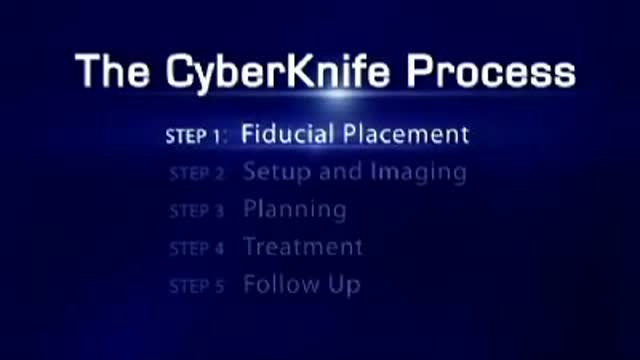 ⁣CyberKnife: Treatment of Lung Cancer