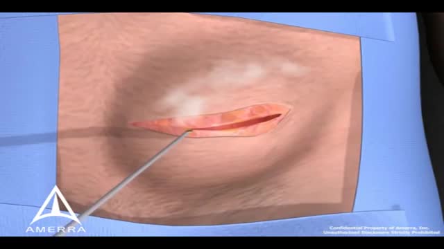 Inguinal Hernia Surgery