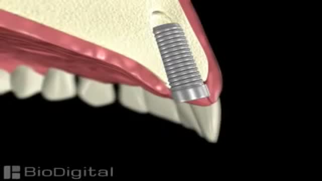 Dental Implant