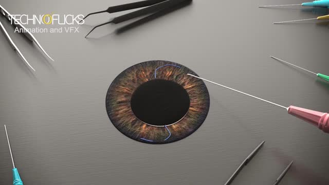 Iris Surgery