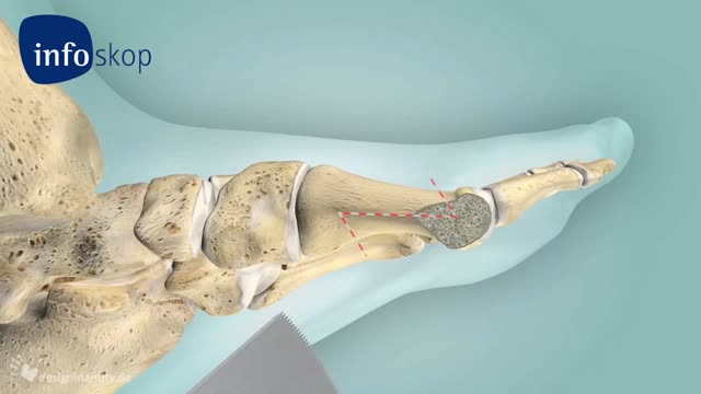 ⁣Osteotomy