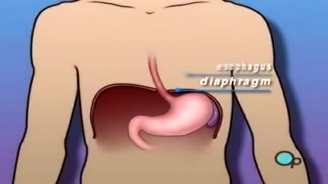 Hiatal Hernia