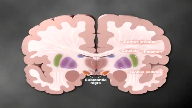 Parkinson's part 1