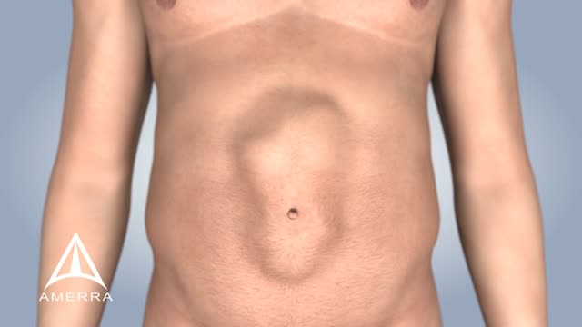 Ventral Hernia Repair