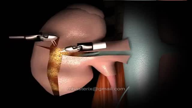⁣Robotic Partial Nephrectomy