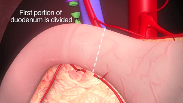 ⁣Total Pancreatectomy with Islet Autotransplantation