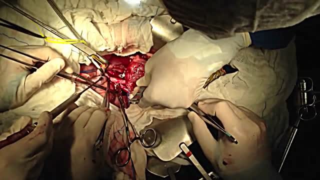 Pancreas transplant