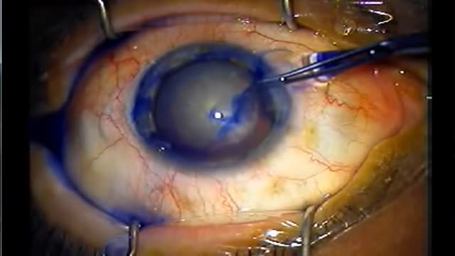 ⁣Cataract Surgery