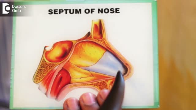 ⁣Deviated nasal septum