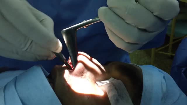⁣Nasal Septal Deviation Surgery