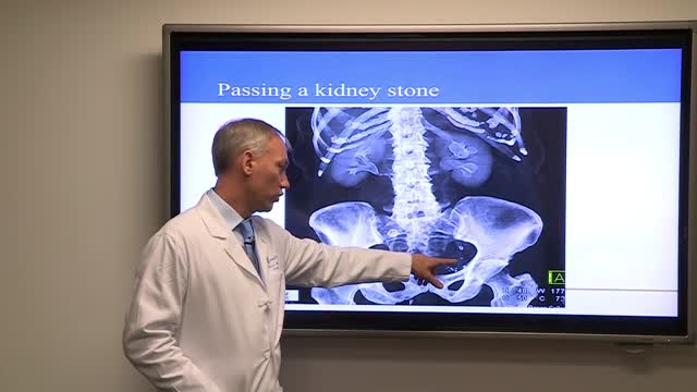 ⁣Latest Advances and Treatments for Kidney Stones