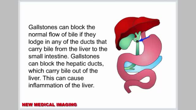 Gallstone.