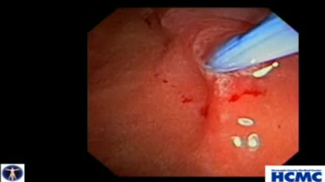 Biliary and Pancreatic Sphincterotomies for Sphincter of Oddi Dysfunction