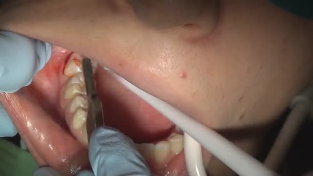 ⁣How to pull a wisdom tooth fully impacted