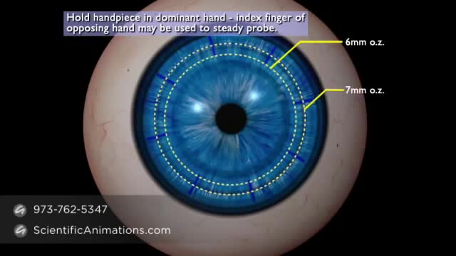 ⁣Conductive Keratoplasty