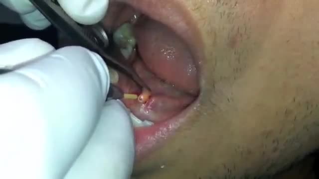 Laser- Removal of Salivary Stone