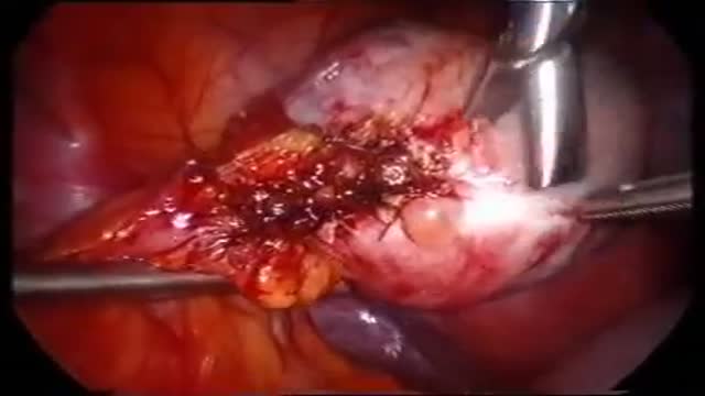 ⁣Bilateral Multiple Ovarian Teratoma