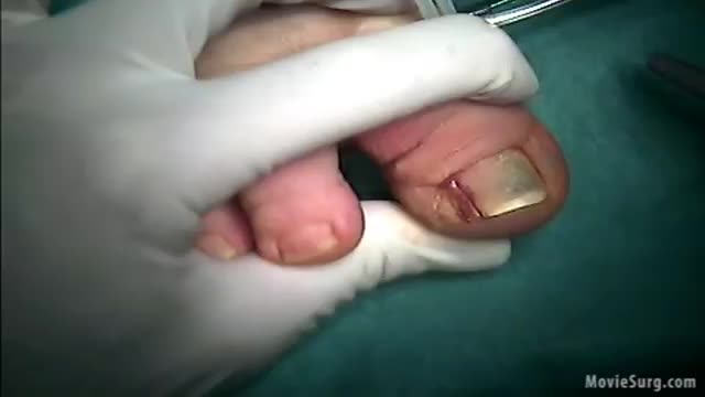 ingrown toenail surgical procedure