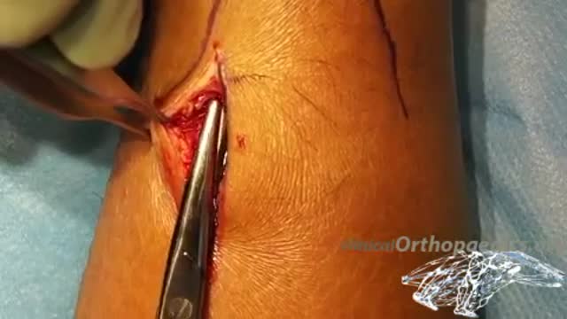 ⁣Mini-invasive surgical repair of a ruptured Achilles tendon