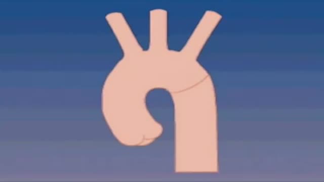 ⁣Coarctation of the Aorta