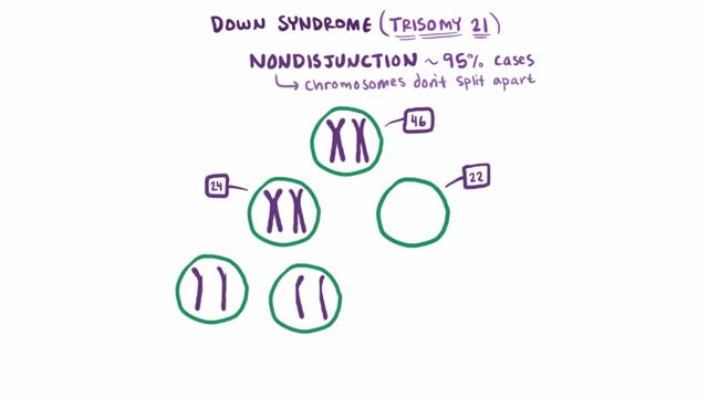 Down syndrome (trisomy 21)