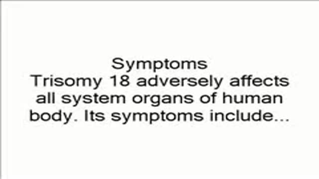 Edwards Syndrome