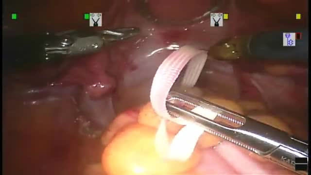 ⁣Robotic Total Mesorectal Excision for Treatment of Rectal Cancer