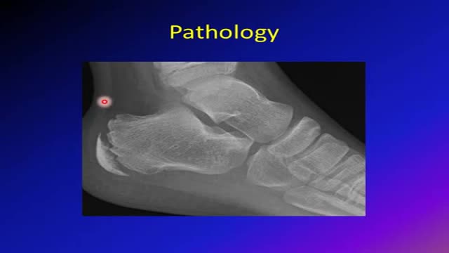 Sever's disease