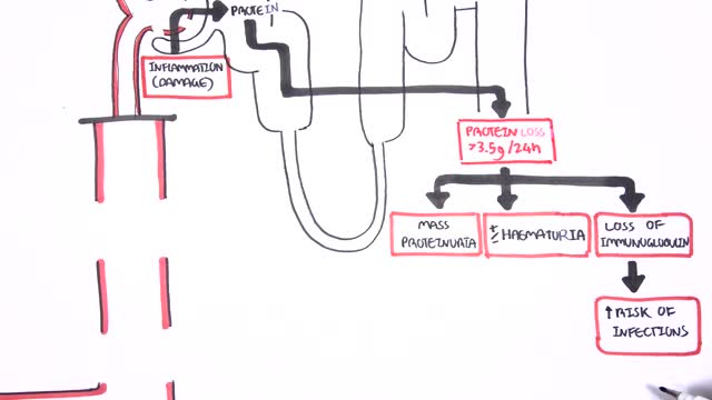 Nephrotic Syndrome