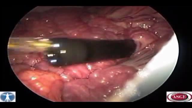 Endoscopic Transgastric Distal Pancreatectomy