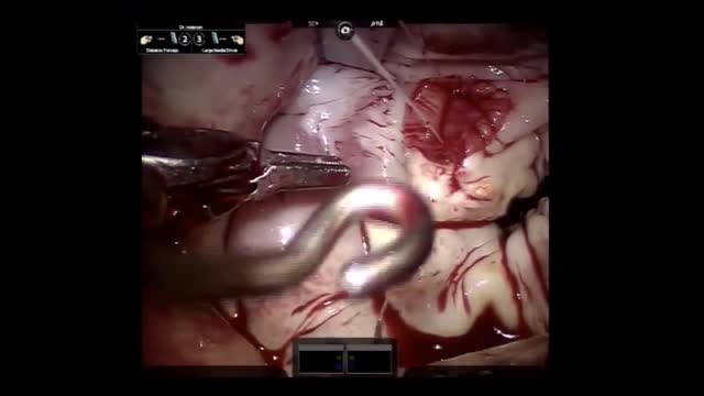 ⁣Mitral valve repair of anterior leaflet perforation and ruptured chordae