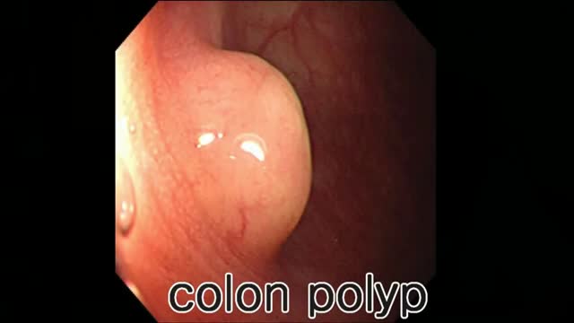 ⁣Colon Polyp