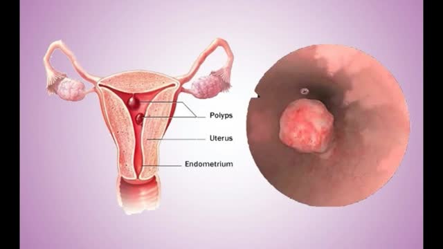 ⁣Endometrial Polyp