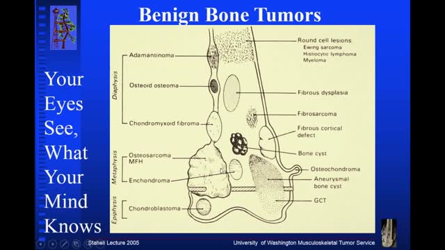 ⁣Benign Bone Tumors