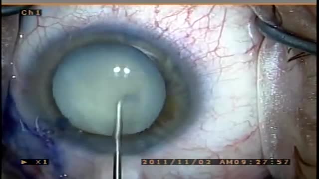 ⁣Great White Cataract Surgery Video