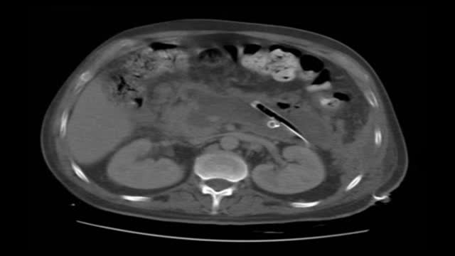 Videoscopic Assisted Retroperitoneal Debridement for infected necrotizing pancreatitis