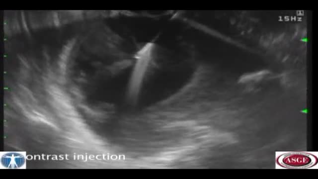 Endoscopic Transgastric Pancreatic Necrosectomy using a Forward Viewing Echoendoscope