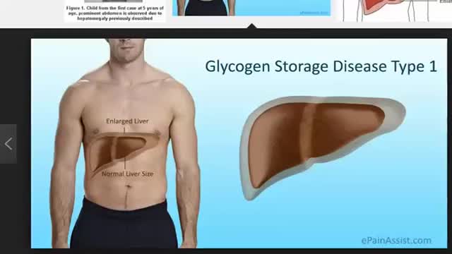 ⁣Von Gerke disease (type 1 glycogen storage disease)