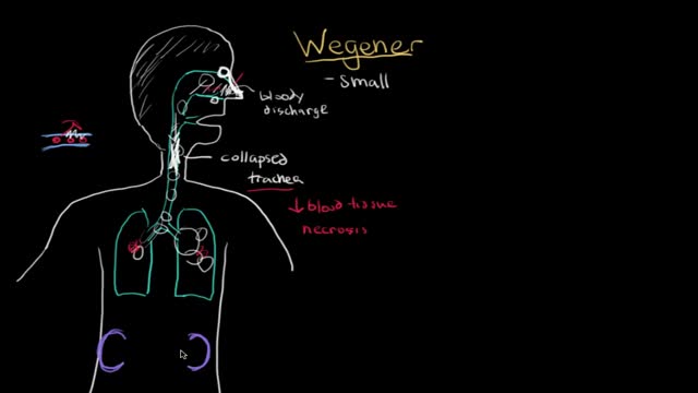 ⁣Wegener granulomatosis and microscopic polyangiitis